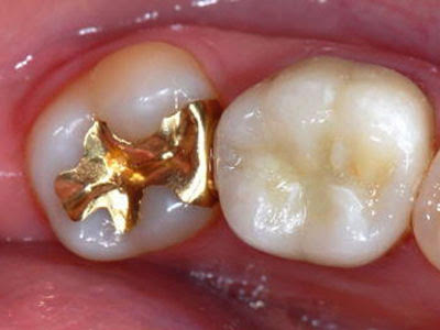 Hat der Zahn große Teile seiner Substanz eingebüßt, bietet eine Krone den.....